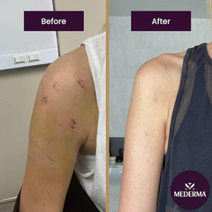 Mederma Advanced Scar Gel 1x Daily Reduces The Appearance Of Old New Scars #1 Doctor Pharmacist Recommended Brand for Scars 1.76oz, Clear, 50 grams