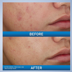 CeraVe Acne Foaming Cream Wash | Gentle Face and Body Acne Cleanser with Benzoyl Peroxide 10%, Hyaluronic Acid, and Niacinamide | Acne Treatment Clears Pimples, Blackheads, Chest and Back Acne | 5 Oz