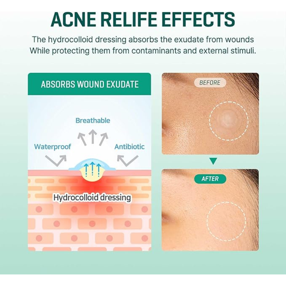 SOME BY MI 30 Days Miracle Clear Spot Patch 18 Pieces